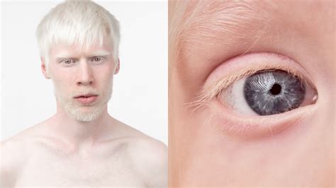 uomo albino|Albinismus: Symptome und Ursachen der。